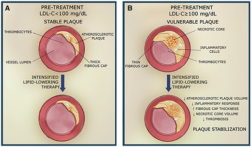 Association between atherosclerotic plaque composition and baseline low-density lipoprotein cholesterol level and intensification of lipid-lowering therapy. (A) Pre-treatment low-density lipoprotein cholesterol < 100 mg/dL and stable plaque, (B) pre-treatment low-density lipoprotein cholesterol ≥ 100 mg/dL and vulnerable plaque. LDL-C, low-density lipoprotein cholesterol.