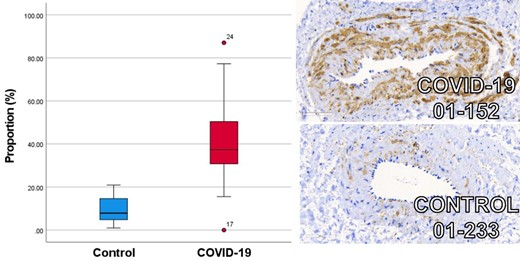 Box and whisker plot of COVID-19 (red) and age, sex, and cardiovascular risk factor matched controls (blue) immunohistochemical staining for phosphorylated myosin light chain antibody uptake. Increased mean proportion of staining for phosphorylated myosin light chain antibody uptake is observed in patients following COVID-19 (n = 21) (40.1%; 95% CI: 30.9–49.3) compared with age, sex, and cardiovascular risk factor matched controls (n = 9) (10.0%; 95% CI: 4.4–15.6) (P < 0.001). Illustrative example images are provided demonstrating the ×40.0 magnification with 60 uM scale bar.