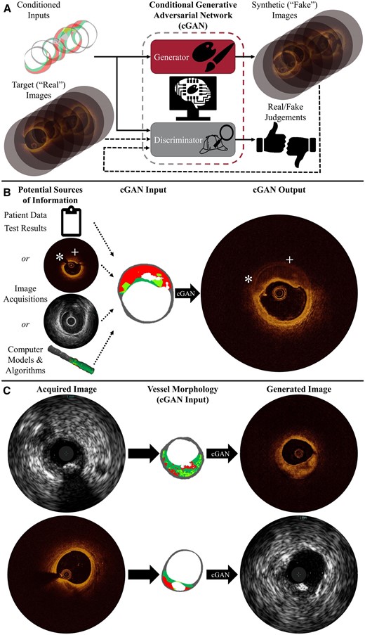 Synthetic image generation addresses shortcomings in medical imaging. Conditional generative adversarial networks transform maps of vascular tissue morphology into synthetic images conveying specified structure in the visual vernacular of imaging systems. (A) The generator learns to produce images—here optical coherence tomography—using feedback from the discriminator, which is trained to distinguish between acquired and synthetic images. (B) Images are generated from morphology, determined using any combination of sources. Surpassing the acquired optical coherence tomography image, the synthetic image shows the complete vessel wall with enhanced far-field feature discrimination in the presence of attenuating plaque; there is no guidewire shadow (*) or obfuscated abluminal features (+). (C) Images can be translated between intravascular ultrasound and optical coherence tomography modality renderings through the shared commonality of underlying (micro)morphology.