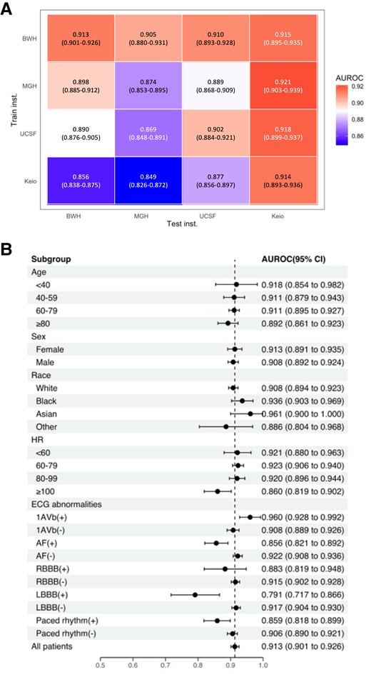 (A) Performance and external validity of models trained at individual institution. (B) Stratification analyses on patient characteristics and electrocardiogram abnormalities in Brigham and Women’s Hospital. AF, atrial fibrillation; CLBBB, complete left bundle branch block; HR, heart rate; PM, pacemaker.