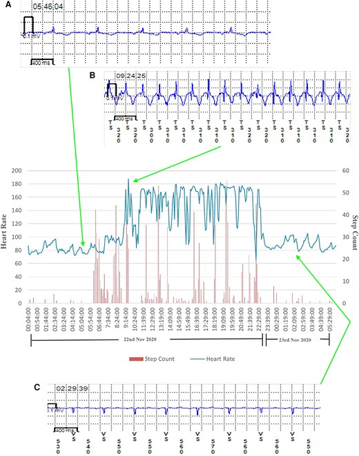 Transition from normal sinus rhythm to atrial tachycardia in a patient with atrial tachycardia recurrence. Heart rate and step count as recorded by a photoplethysmography and accelerometer-enabled wrist-worn device demonstrate a period of fixed maximum rate tachycardia and increased beat-to-beat variability, which correlates with implantable loop recorder-confirmed paroxysmal atrial tachycardia. (A) Implantable loop recorder electrogram showing normal sinus rhythm, (B) implantable loop recorder electrogram showing atrial tachycardia, and (C) implantable loop recorder electrogram showing cardioversion back to normal sinus rhythm.