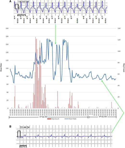 Transition from normal sinus rhythm to atrial fibrillation in a patient with atrial fibrillation recurrence. Heart rate and step count as recorded by a photoplethysmography and accelerometer-enabled wrist-worn device demonstrate a period of variable rate tachycardia and increased beat-to-beat variability, which correlates with implantable loop recorder-confirmed paroxysmal atrial fibrillation. (A) Implantable loop recorder electrogram showing atrial fibrillation and (B) implantable loop recorder electrogram showing normal sinus rhythm.