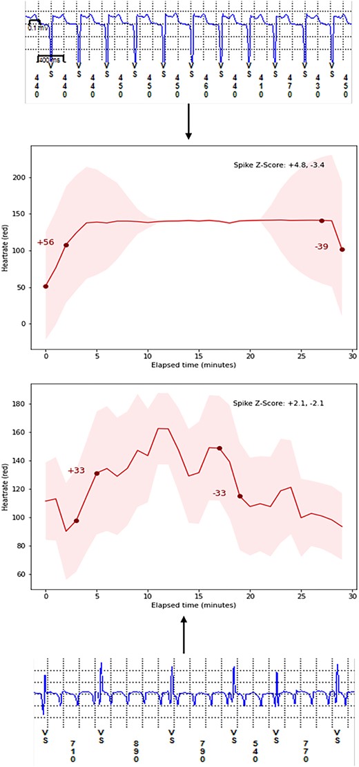 Demonstration of our underlying composite method to detect atrial fibrillation/atrial tachycardia recurrence by utilizing matching onset and offset for heart rate delta change (spike score) and subsequent arrhythmia recurrence as detected by implantable loop recorder. A normalized spike score ≥ 0.75 for both onset and offset of tachycardia is more likely to represent an episode of atrial arrhythmia recurrence due to a sudden increase in heart rate rather than exercise induced tachycardia with a gradual increase in heart rate. LoTO in CASA LSPAF, long-term outcomes in long-standing persistent atrial fibrillation RCT (ClinicalTrials.gov Identifier: NCT04280042). ILR, implantable loop recorder.