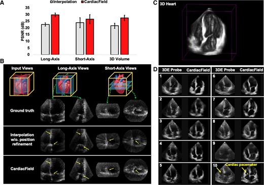 An assessment of image quality. (A) We evaluated the image quality of three-dimensional hearts reconstructed by CardiacField and a conventional interpolation method, comparing them against real-captured three-dimensional hearts. For quality assessment, we used peak signal-to-noise ratio scores, where higher values indicate better image quality, across newly generated long-axis views, short-axis views, and the overall three-dimensional volume. (B) We demonstrated the ‘continuous-slicing’ capability of CardiacField in contrast to the conventional interpolation method. By extracting and comparing the same views from different methods, we showed that CardiacField can produce arbitrary views while avoiding the interpolation artefacts, which are marked with yellow arrows. (C) We used CardiacField to reconstruct realistic three-dimensional heart with real-captured two-dimensional echocardiographic images. (D) We compared apical four-chamber cross-sectional views of hearts reconstructed by CardiacField with those captured by a three-dimensional probe across 10 patients. The results highlighted that CardiacField’s reconstructions were more detailed and exhibited fewer artefacts compared with those by the three-dimensional probe.