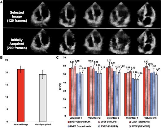 Generalization to novice users. (A) We conducted an experiment with 50 participants divided into four groups based on their background. Each performed a simple apical ring scan using CardiacField, capturing ∼200 images. Our algorithm then selected the top 120 images for high-quality three-dimensional reconstruction, resulting in images with fewer artefacts and clearer structural details compared with reconstructions from the full, unselected data sets. (B) The system achieved a higher peak signal-to-noise ratio in selected images compared with the full data set, showcasing the algorithm’s efficiency in image selection across diverse backgrounds. (C) Additionally, we reconstructed three-dimensional hearts and calculated ejection fractions for five volunteers using two different two-dimensional ultrasound machines commonly found in clinics. The consistent results across different machines highlighted the robust generalization capabilities of our method. PSNR, peak signal-to-noise ratio.