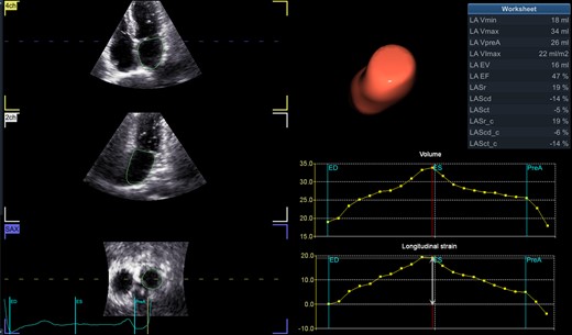 Three-dimensional speckle tracking echocardiographic quantification of left atrial volumes and function. (Left) Longitudinal and transverse visualization of three-dimensional echocardiographic left atrial volume. (Right) Left atrial volume–time and strain–time curves showing changes during the cardiac cycle. LA, left atrium; LAEF, total emptying fraction (total EV/Vmax); LAEV, total emptying volume (Vmax − Vmin); LAScd, longitudinal strain conduit phase; LAScd_c, circumferential strain conduit phase; LASct, longitudinal strain contraction phase; LASct_c, circumferential strain contraction phase; LASr, longitudinal strain reservoir phase; LASr_c, circumferential strain reservoir phase; LA-VImax, maximum volume index; LA-Vmax, maximum volume (at LV end-systole); LA-Vmin, minimum volume (at LV end-diastole); LA-VpreA, volume before atrial contraction (at LV early diastole). LA expansion index, LAEV/Vmin × 100.