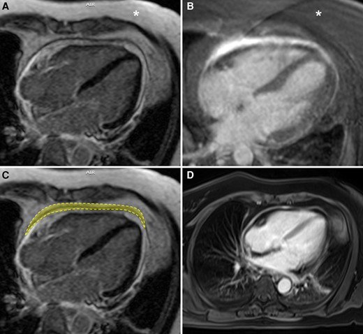 Forty-year-old male presented with acute chest pain. Initial evaluation excluded coronary artery disease. MRI was requested to evaluate for myocarditis and showed pericardial thickening and enhancement. A significant difference can be seen between the areas of hyperintense signal in LGE sequences without and with fat saturation (A and B, respectively). Note the difference in subcutaneous fat signal intensity (asterisk) in A and B to differentiate between the non-fat-suppressed and fat-suppressed sequences, respectively. The area of ‘true’ pericardial enhancement (outlined) appears markedly reduced in the sequence without fat saturation (C). Pericardial thickening and enhancement can also be characterized in post-contrast non-gated Dixon-type T1-weighted sequence (D). Technical parameters: (A) non-fat-saturated inversion recovery prepared gradient echo pulse sequence (TR = 881.6 ms, TE = 4.72 ms, FOV = 380, matrix = 232 × 256, flip angle = 25°); (B) fat-saturated inversion recovery prepared gradient echo pulse sequence (TR = 630.6 ms, TE = 1.74 ms, FOV = 400, matrix = 232 × 256, flip angle = 20°); and (D) dual-echo volumetric interpolated breath-hold examination (VIBE)-Dixon T1-weighted sequence (TR = 6.8 ms, TE1 = 2.39 ms, TE2 = 4.77 ms, FOV = 380, matrix = 256 × 320, flip angle = 8°).