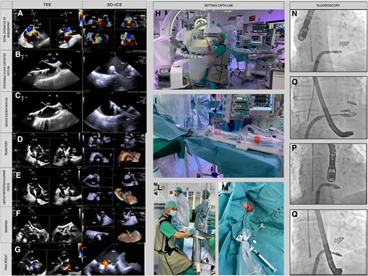 Combining echocardiographer-guided 3D ICE and TEE in T-TEER. The left panel compares the same step of the T-TEER monitored with both TEE and 3D ICE. (A) Colour flow imaging with both modalities. (B) The insertion of the guiding catheter into the right atrium. (C) The insertion of the device into the right atrium. (D) The steering of the implant catheter to obtain a straight trajectory on the tricuspid valve. (E) The retention elements of the device for independent grasping. (F) Leaflet insertion into the device is assessed with TEE and ICE imaging. (G) The assessment of residual regurgitation. Central panel shows the cath lab setup with the echocardiographer able to switch between 3D ICE and TEE (H–L). (I and M) The use of TJ access for positioning the 3D ICE probe with a standard valved straight introducer sheath. Right panel show TEE and ICE probe position under fluoroscopy. The position of devices from right oblique projection (N and O) and antero-posterior projection (P and Q), with the TEE probe in mid-oesophageal position in N and P and in transgastric position in O and Q. IAS, interatrial septum; IVC, inferior vena cava; LA, left atrium; RA, right atrium; RV, right ventricle; SVC, superior vena cava.