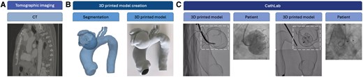 Example of creation and application of a 3D printed model from bench to cath lab: CT image (A), 3D printing model creation (B), and two different phases of the device deployment in the printed model in the CathLab (C).