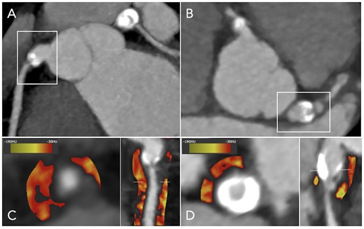 PCAT density in a patient with TAK and bilateral coronary aneurysms. Coronary computed tomography angiography showing calcified aneurysms of the (A) right coronary artery and the (B) left main coronary artery in a 28-year-old woman with TAK, with significant coronary stenoses immediately distal to the aneurysms. PCAT density displayed using colour heatmap is increased around these vessels, as shown in (C and D) cross-section and curved multi-planar views. PCAT, pericoronary adipose tissue; TAK, Takayasu arteritis