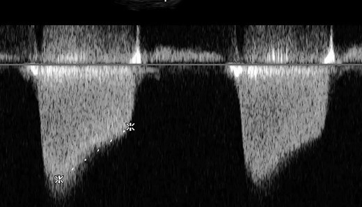 Increased velocity time integral indicating mitral stenosis on transoesophageal echocardiography (TOE).