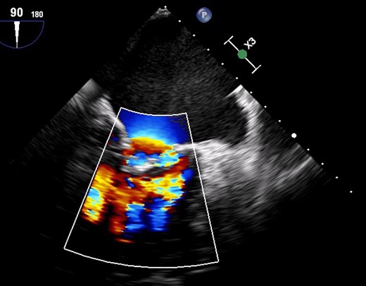 Colour Doppler due to severe mitral regurgitation and stenosis.