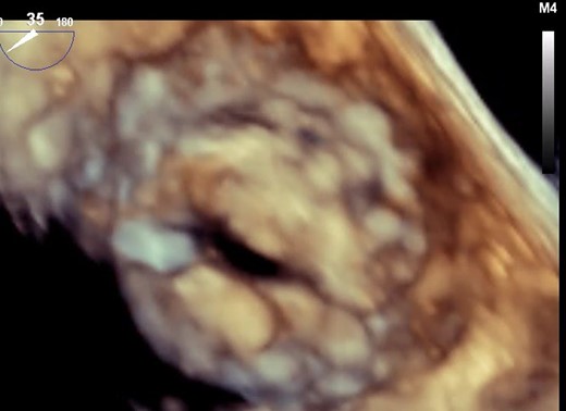 3D TOE for rheumatic heart disease-related mitral stenosis. TOE, transoesophageal echocardiography.