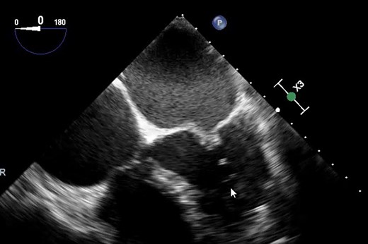 Classical hockey stick appearance on transoesophageal echocardiography (TOE).