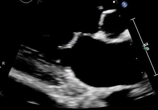 Severe rheumatic mitral valve disease on transthoracic echocardiography (TTE).