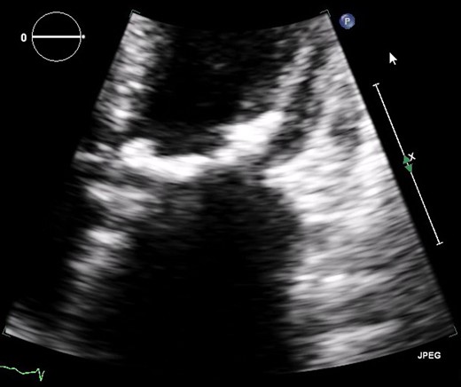 Severe mitral valve calcification on transthoracic echocardiography (TTE).