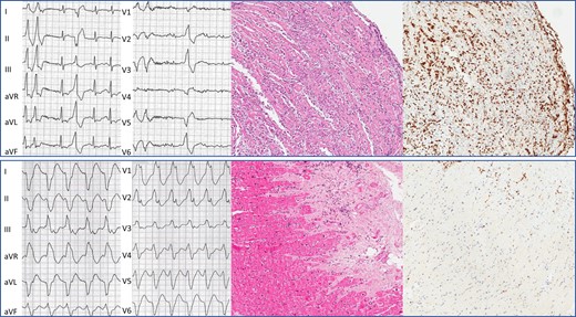 Representative examples of the spectrum of ventricular arrhythmias in viral myocarditis. Representative examples of ventricular arrhythmias in patients with different stages and viral aetiologies are shown. In particular, from the left to the right, the upper and lower panels show (i) 12-lead electrocardiogram features of arrhythmias; (ii) haematoxylin–eosin assay on endomyocardial biopsy; and (iii) immunohistochemistry assay on endomyocardial biopsy with CD3+ T lymphocytes labelled. Upper panel: polymorphic ventricular ectopic beats in a patient with fever and endomyocardial biopsy–proven acute myocarditis caused by adenovirus. Endomyocardial biopsy shows high prevalence of inflammatory infiltrates and trivial fibrosis. Lower panel: monomorphic ventricular tachycardia in a patient with endomyocardial biopsy–proven chronic myocarditis and evidence of low-load (i.e. <500 copies/µg) parvovirus B19. Endomyocardial biopsy shows high prevalence of replacement fibrosis and low degree of lymphocytic inflammatory infiltrates. This patient presented with no signs or symptoms of systemic infection. CD, cluster of differentiation.
