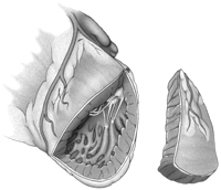 PLV involves resecting a wedge-shaped portion of left ventricle in the circumflex coronary artery distribution.