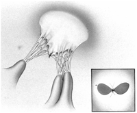A suture is used to approximate the central portion of the free edge of the anterior and posterior mitral leaflets to reduce MR (Alfieri repair).