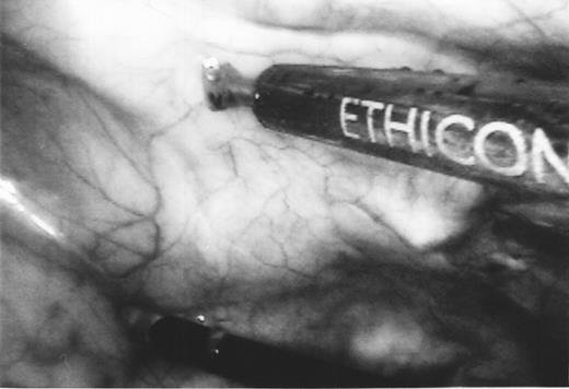 Thoracoscopic view of the Harmonic Scalpel and endoscopic kittner dissector used for IMA harvest in the insufflated left hemithorax. Arrows, proximal portion of the LIMA; Arrow head, first rib.