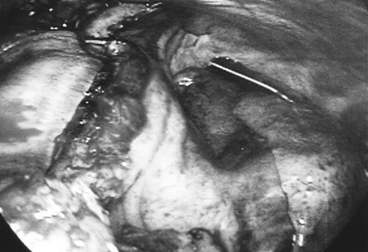 Thoracoscopic view of the LIMA graft after completion of anastomosis to the LAD. The LIMA was harvested higher than the first rib and the graft had a comfortable lie on the mediastinum with no tension.