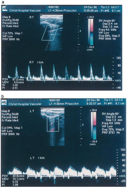 Pulsatile wave color Doppler study for the IMA performed 6 months after operation. In the unused RIMA, the flow was mainly systolic (a). Diastolic flow velocity remarkably increased in the LIMA anastomosed to the LAD (b).