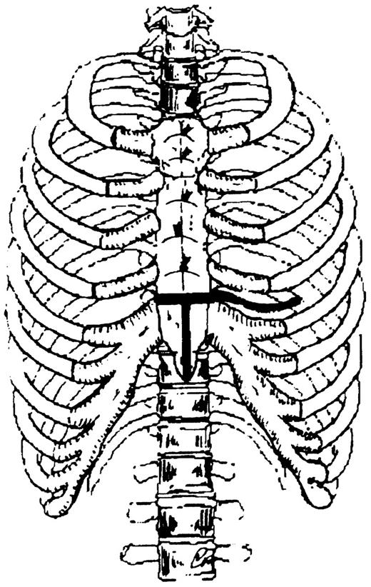 The chest and the incision of the lower third of the sternum is shown. The top of the incision can be extended to the right or to the left, carrying it into the intercostal space.