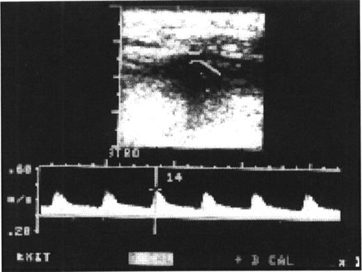 The Doppler echocardiogram postoperatively is showing a good diastolic flow pattern, verifying the patency of the RGEA.