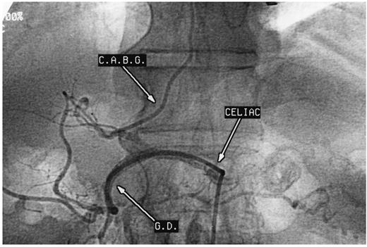 Selective postoperative catheterization of the RGEA with excellent distal filling of the right coronary artery and retrograde filling of the proximally obstructed vein graft.