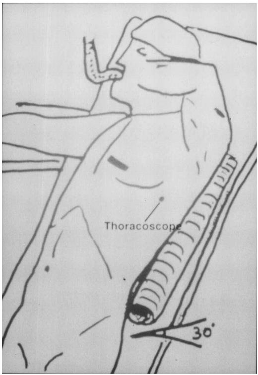 The patient is placed in a recumbent position, with the left arm placed upwards. Two back rolls are positioned under the left shoulder. The left thoracotomy is represented at the fourth intercostal space. In the drawing, the thoracoscope is inserted at the fifth intercostal space along the median axillary line.