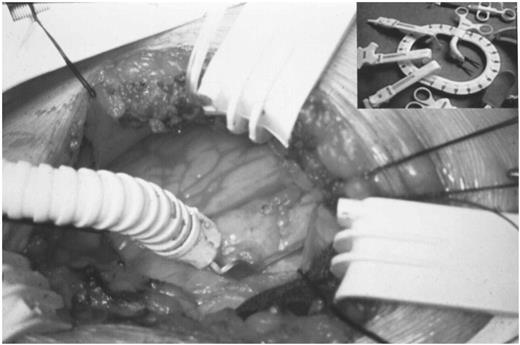 The LIMA, coming from the right, is anastomised to the left anterior descending artery. The LAD stabilized is locked into place, with the LAD centered between the tines. In the table above is shown the wound spreader.