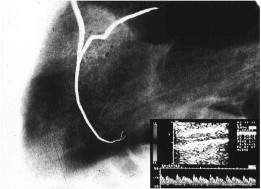Postoperative angiographic control of LIMA graft to LAD. In the table below is shown the early echo-Doppler study.