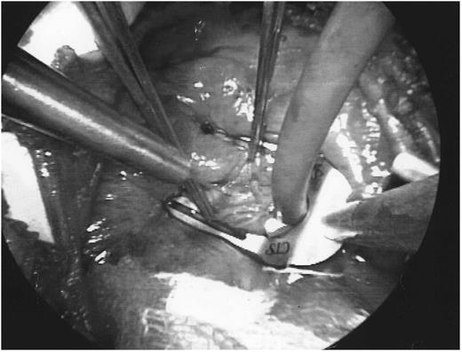 The stabilizing arm of the retractor (CardioThoracic Systems) is used to provide field stability with the help of a looping suture around the LAD proximal to the anastomotic site.