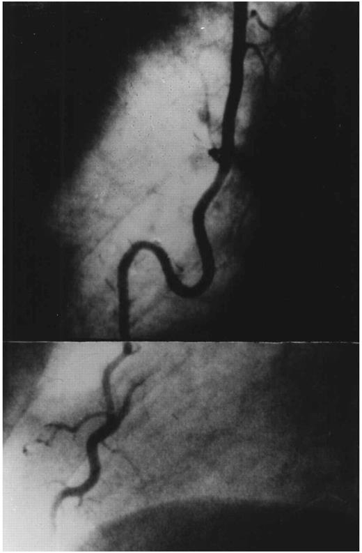 Routine postoperative coronary angiogram showing a patent left internal mammary artery to left anterior descending coronary artery anastomosis and adequate length of the mammary artery pedicle.