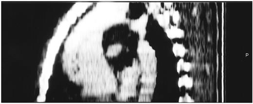 Spiral angio C.T. scan (multiplanar reconstruction). Note the aortic aneurysm, intimal flap, hypoplastic arch and isthmic coarctation.