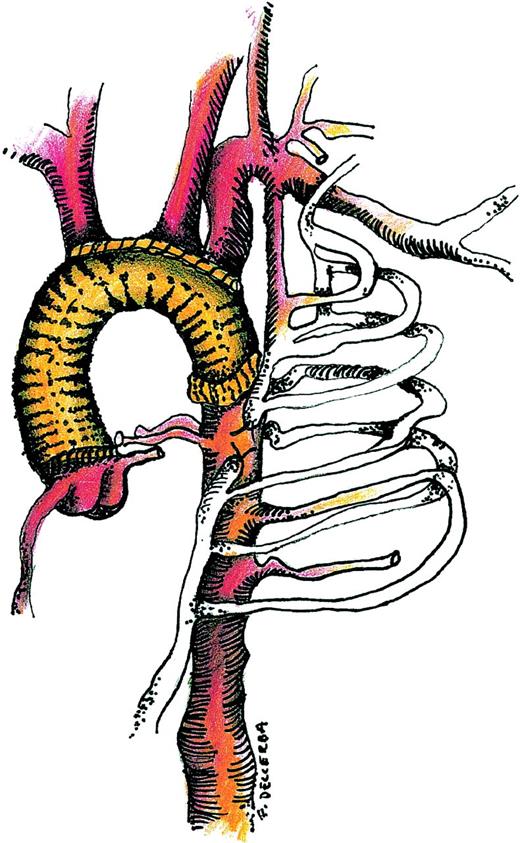 Combined replacement of the ascending aorta, arch and isthmic coarctation.