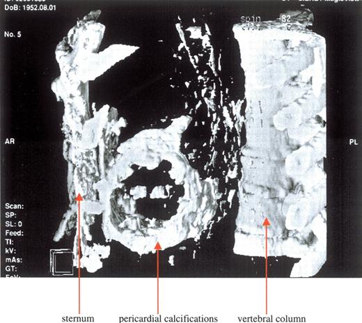 CT scan (3 dimensional) demonstrating massive pericardial calcifications.