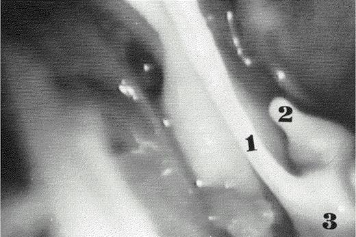 A ruptured primary mitral chordae was detected during the operation by means of a 10-mm Storz endoscope (Karl Storz, Tuttlinger, Germany). (1) Chordae tendina ad integrum. (2) Ruptured mitral chordae tendina. (3) Posterior papillary muscle.