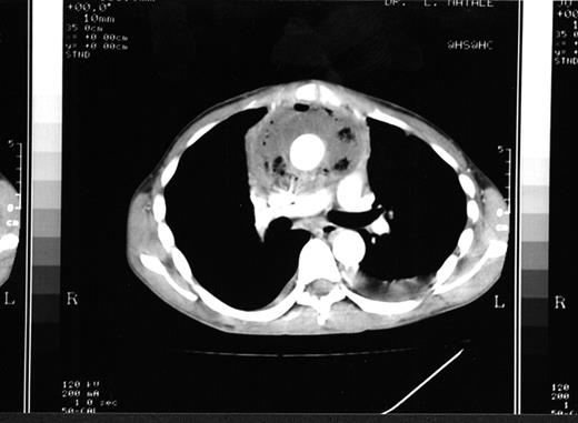 CT scan showing mediastinitis with a large periprosthetic collection surrounding the aortic prosthetic graft.