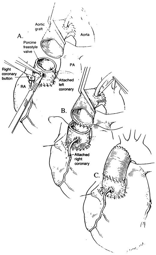 (A) The arterial cannula has already been moved to the Hemashield®-tube graft, which has been anastomosed to the distal ascending aorta. The Freestyle® porcine valve is used to replace the aortic root. The right coronary button is anastomosed to the appropriate position on the Freestyle® valve. (B) The Freestyle® valve is anastomosed to the Hemashield®-tube graft with running 4-0 Prolene®. This is the only additional step required compared to using a mechanical valve conduit. (C) The completed composite replacement of the aortic valve, root, and ascending aorta is shown.