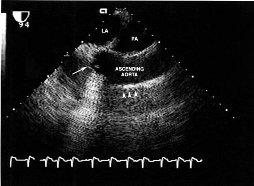 Post-operative transesophageal echocardiogram of final reconstruction: LA, left atrium; PA, pulmonary artery; long arrow, Freestyle® aortic valve; short arrows, Hemashield®-tube graft.