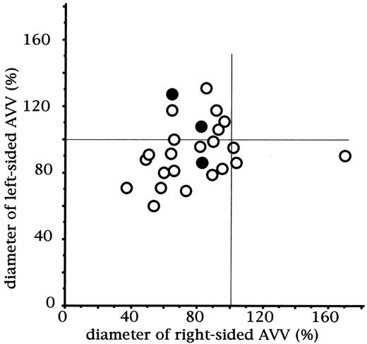 Diameter of the right-sided and the left-sided AV valves in patients with DIRV. Measurement was carried out on ventriculography prior to the Fontan procedure and standardized by the anticipated normal value. The black dots indicate values derived from patients having moderate or severe regurgitation across the right-sided AV valve. AVV, atrioventricular valve.