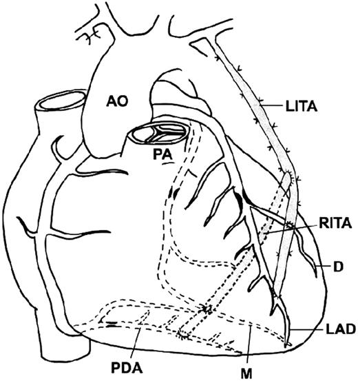 The ‘cross’ arrangement: right ITA to LAD, diagonal artery (small Y-graft) and left ITA to marginal artery.