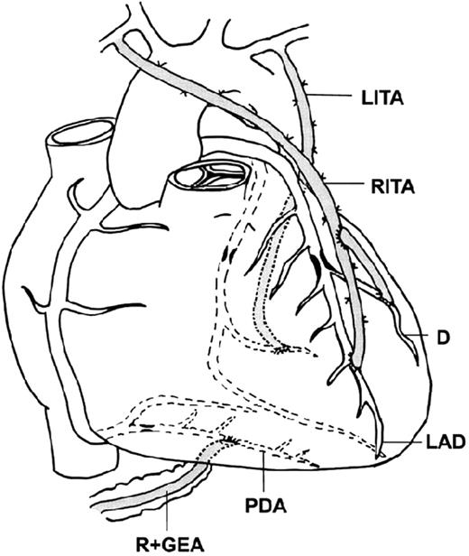 A composite graft. A free right ITA is connected end-to-side to an in-situ left ITA.