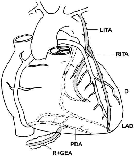 In-situ left ITA to marginal and free right ITA to LAD.