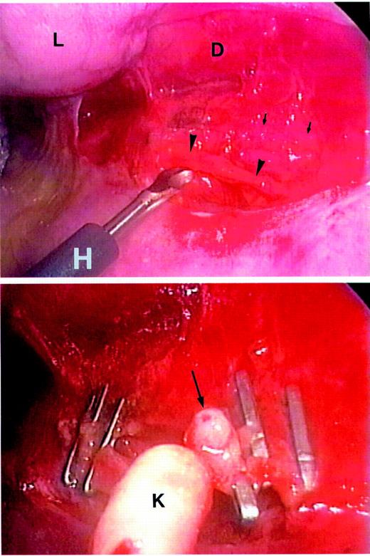 Thoracoscopic view of thoracic duct exposure and division. (Top) The thoracic duct (arrowheads) exposed by a hook blade of the Harmonic Scalpel (H). Arrows indicate vagal nerve. D, descending aorta; L, lung. (Bottom) The divided thoracic duct showing its tubular appearance (arrow). K, endoscopic Kitner dissector.
