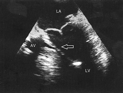 Transesophageal echocardiography five-chamber view. A structure is seen in the left ventricular outflow tract (arrow) extending from the mitral valve annulus to a papillary muscle. AV, aortic valve; LA, left atrium; LV, left ventricle.