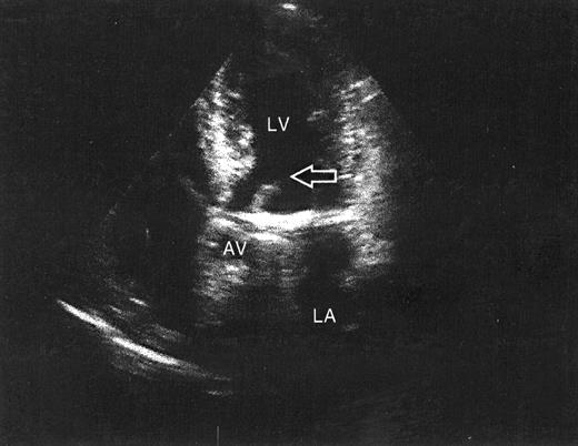 Transthoracic echocardiography apical long-axis view of the left ventricle. A rim of tissue, apparently the preserved anterior subvalvular apparatus of the mitral valve, is seen in the left ventricular outflow tract (arrow). AV, aortic valve; LA, left atrium; LV, left ventricle.
