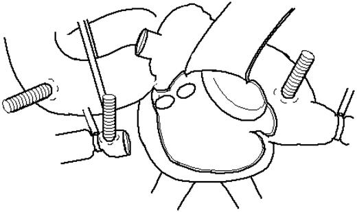 Schema of the superior vena cava (SVC) division. SVC is divided at about 2 cm above the cavo-atrial junction.