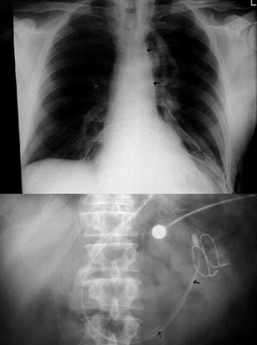 Plain chest (top); and abdominal (bottom) radiographs taken in the immediate postoperative period, to confirm accurate positioning of the feeding tube. The aspiration lumen and feeding lumen are both visible (arrowed) in the gastric tube and proximal small bowel.